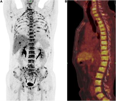 Treatment of Metastatic Primary Extramammary Paget Disease With Combination Anlotinib and Tislelizumab: A Case Report and Review of the Literature